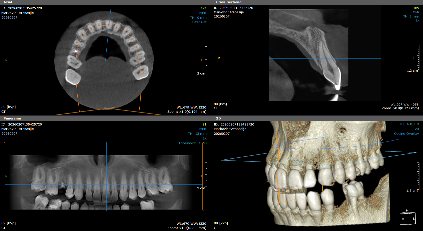 3d snimanje zuba cbct