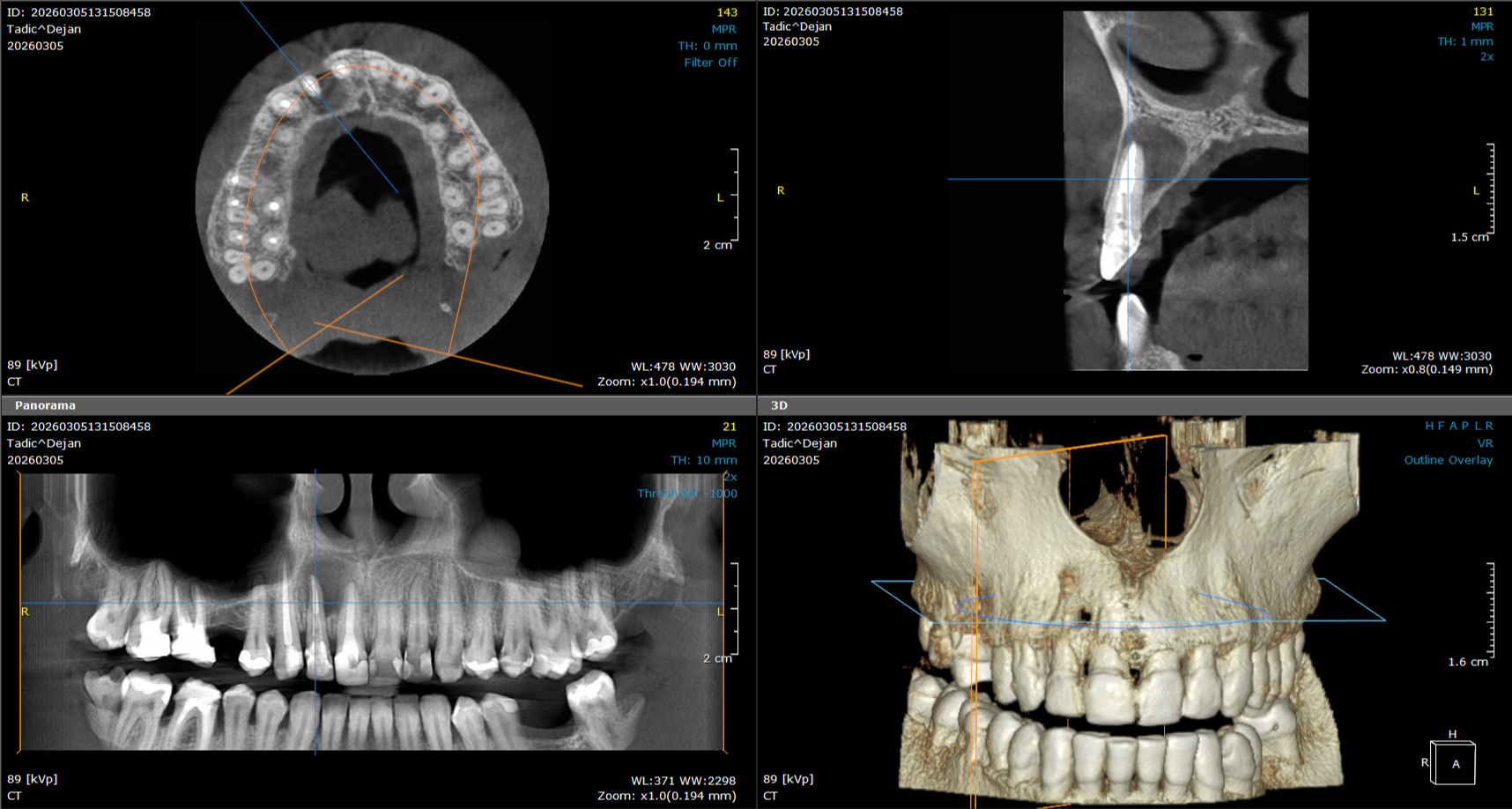 3d snimanje zuba ciste i patoloske promene