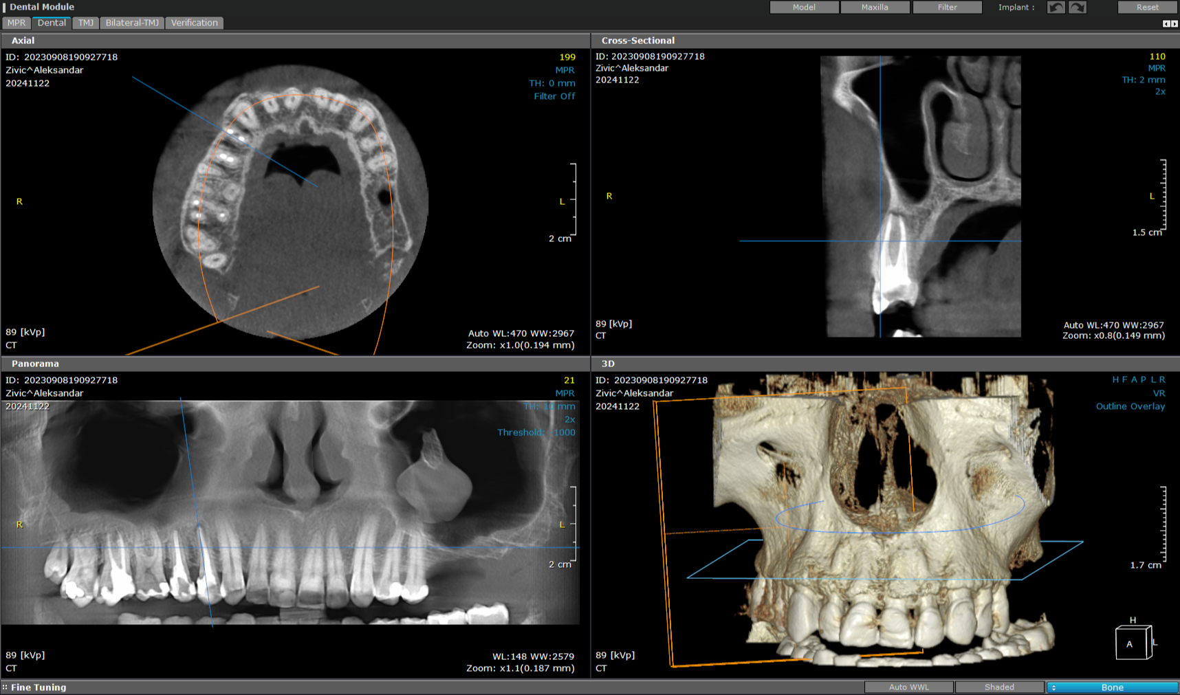 3d snimanje zuba endodoncija