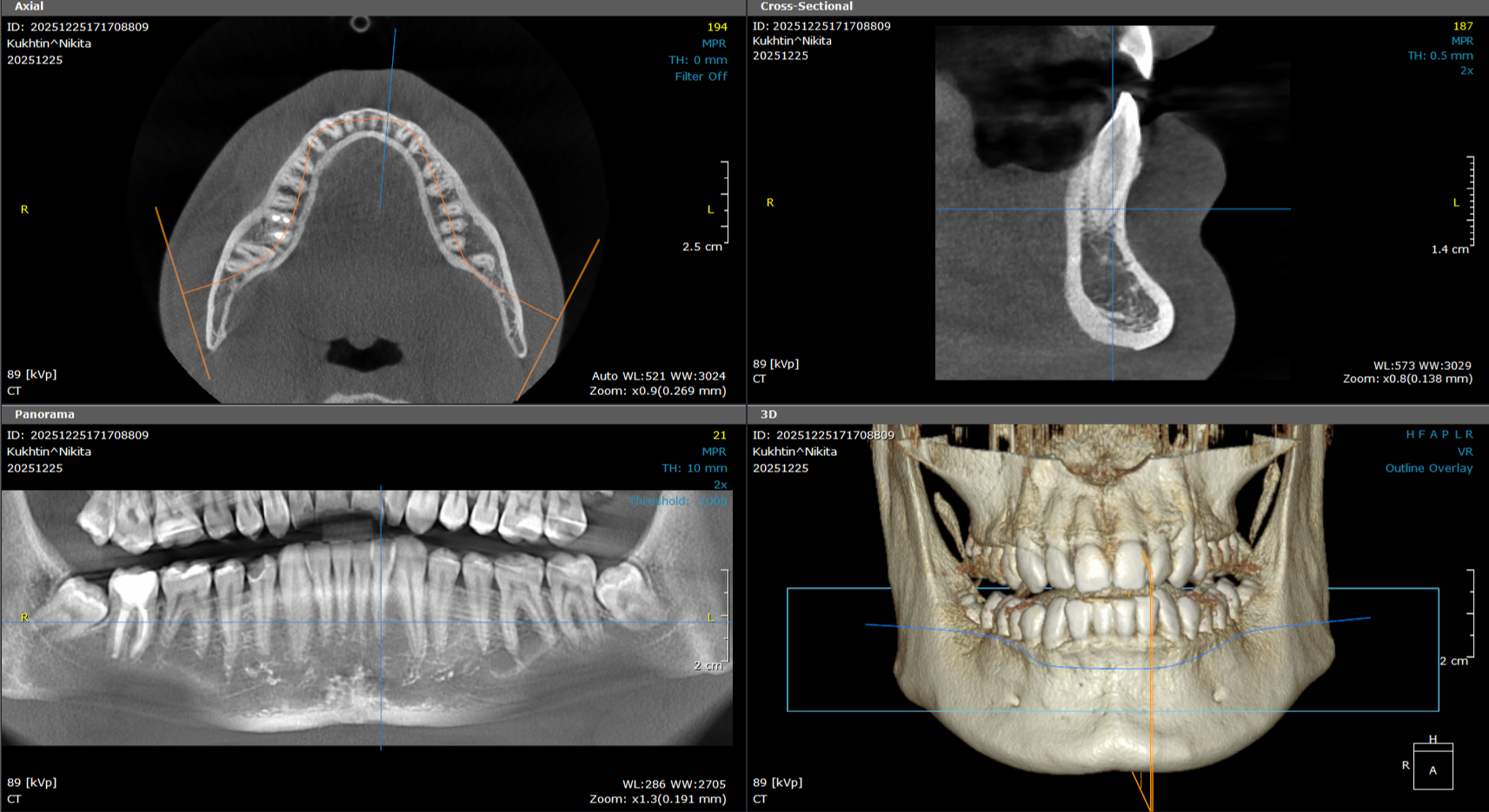 3d snimanje zuba impaktirani umnjaci