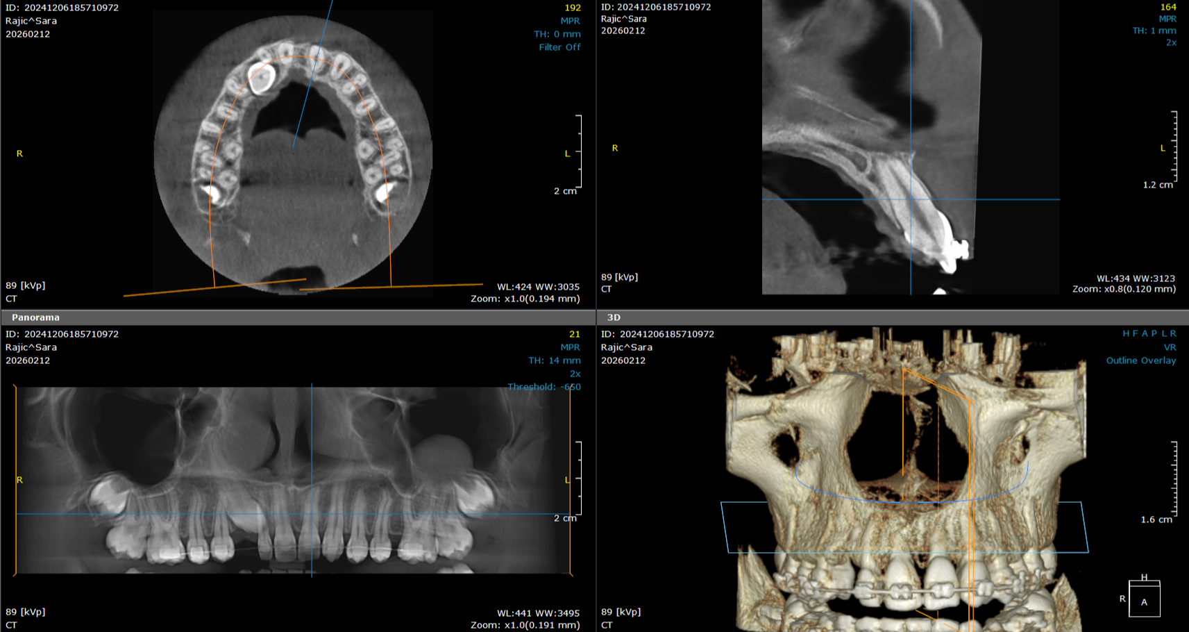 3d snimanje zuba ortodoncija