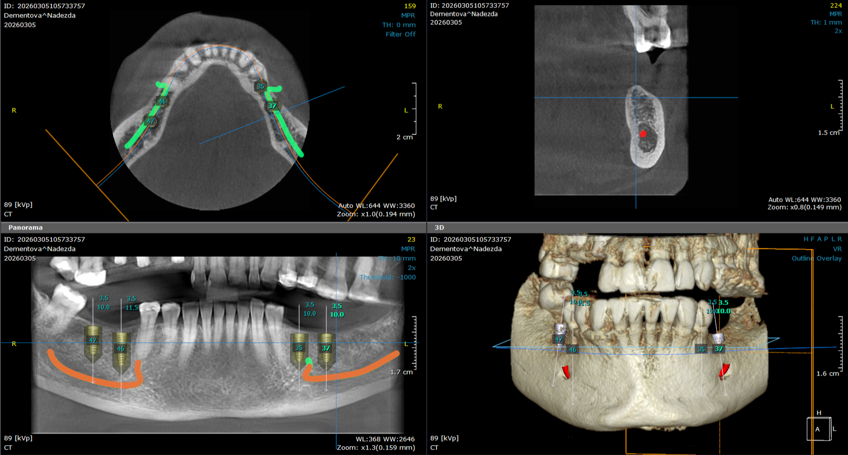 3d snimanje zuba planiranje ugradnje mplantata