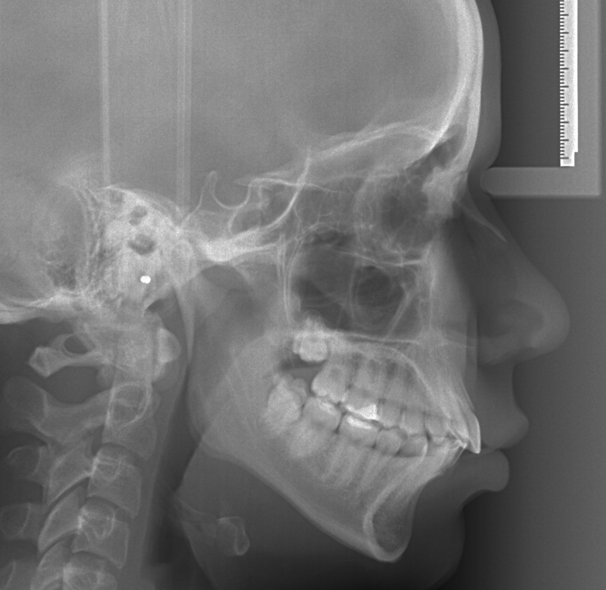 3d snimanje zuba telerendgen